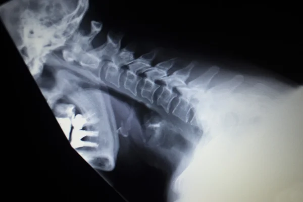 X-ray orthopedics Traumatology scan of neck injury — Stock Photo, Image