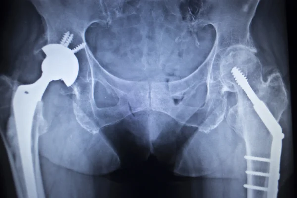 Kalça eklemi replasman ortopedik implant X-Ray tarama görüntü