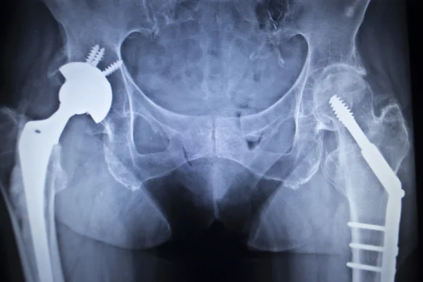 Imagem radiográfica do implante ortopédico de substituição da articulação do quadril — Fotografia de Stock