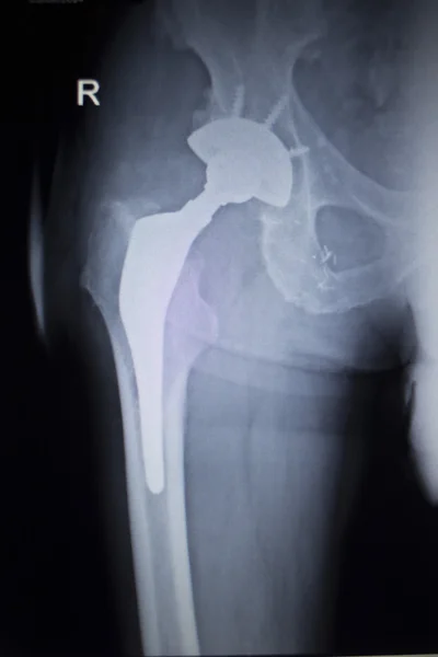 X-ray skanowania obraz stawu biodrowego wymiany implantów ortopedycznych — Zdjęcie stockowe