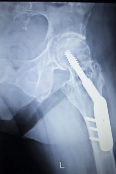 Kalça eklemi replasman ortopedik implant X-Ray tarama görüntü — Stok fotoğraf