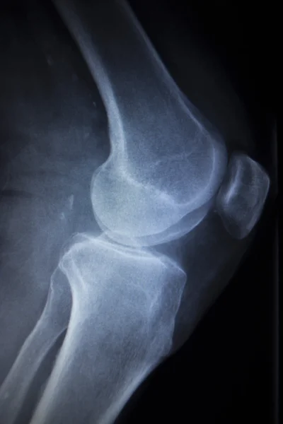 Radiographie orthopédique scan des blessures douloureuses aux jambes du ménisque du genou — Photo