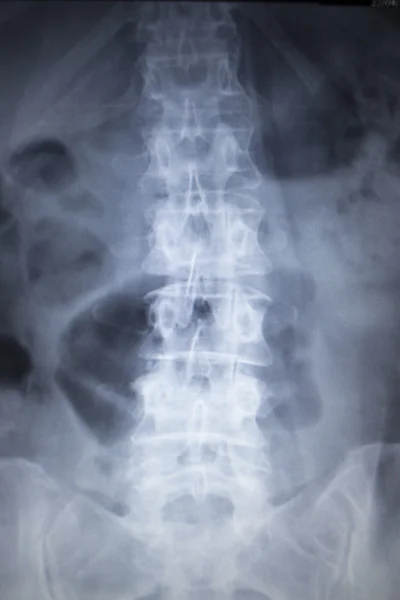 Rentgen traumatologie ortopedie, skenování zranění páteře bolesti zad — Stock fotografie