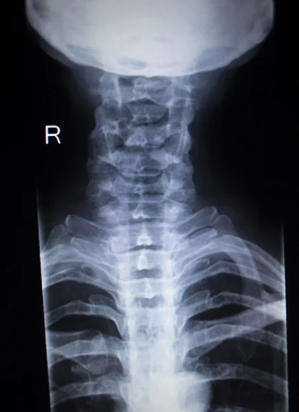 X-Ray Orthopedie-traumatologie scan van nekletsel — Stockfoto