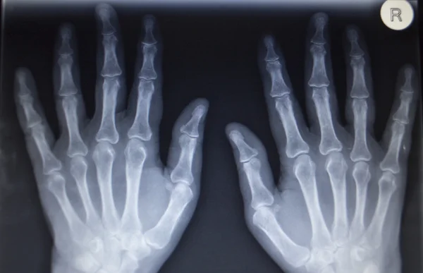 Ortopedia por rayos X Traumatología: exploración de lesión en el dedo de la mano — Foto de Stock