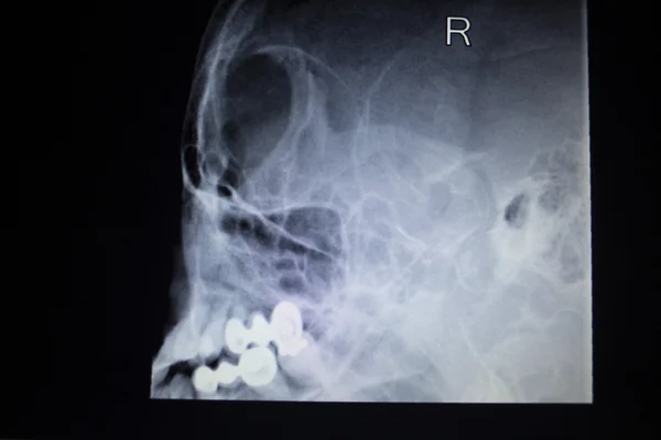 X-ışını ortopedi Travmatoloji tarama burun yaralanma nefes — Stok fotoğraf
