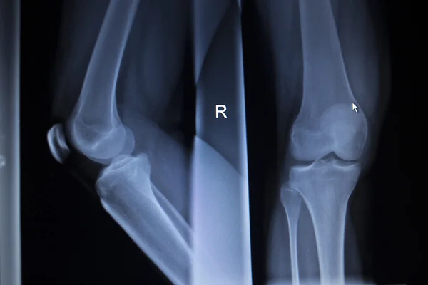 X-ray orthopedics scan of painful knee meniscus leg injury — Stock Photo, Image
