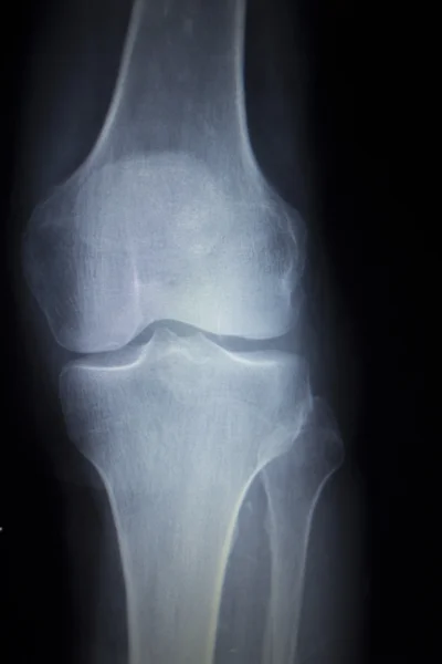 X-ray ortopedi genomsökning av smärtsamma knäskada menisken ben — Stockfoto