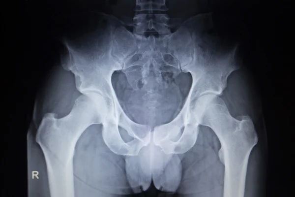 Exploración ortopédica por rayos X de las articulaciones de la cadera esqueleto humano — Foto de Stock