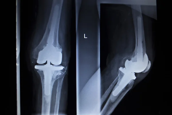 X-ray orthopedics scan of knee meniscus implant prosthetics — Stock Photo, Image