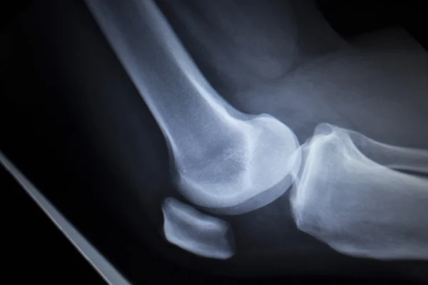 Radiographie orthopédique scan des blessures douloureuses aux jambes du ménisque du genou — Photo