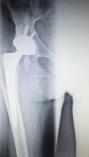 Imagem radiográfica do implante ortopédico de substituição da articulação do quadril — Fotografia de Stock