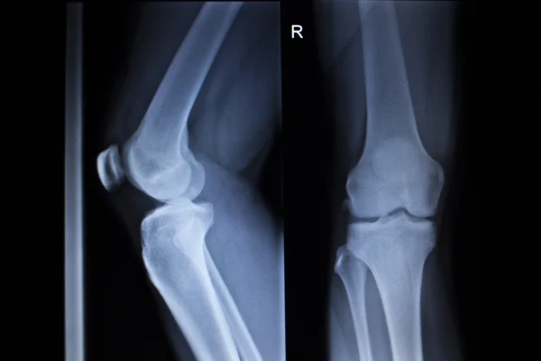 X-Ray orthopedie scan van pijnlijke knie meniscus been blessure — Stockfoto