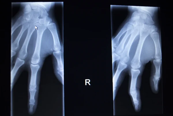 Ortopedia por rayos X Traumatología: exploración de lesión en el dedo de la mano — Foto de Stock