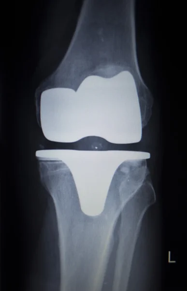 Radiographie orthopédique scan des prothèses du ménisque du genou — Photo