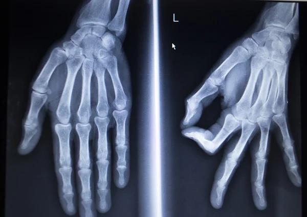 Ortopedia por rayos X Traumatología: exploración de lesión en el dedo de la mano —  Fotos de Stock