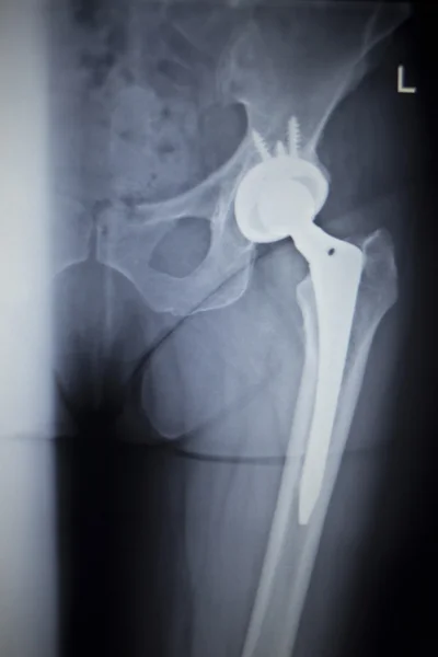 X-ray scan  image of hip joint replacement orthopedic implant — Stock Photo, Image