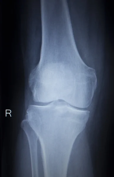 Radiographie orthopédique scan des blessures douloureuses aux jambes du ménisque du genou — Photo