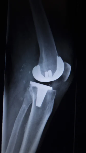X-ray orthopedics scan of knee meniscus implant prosthetics — Stock Photo, Image