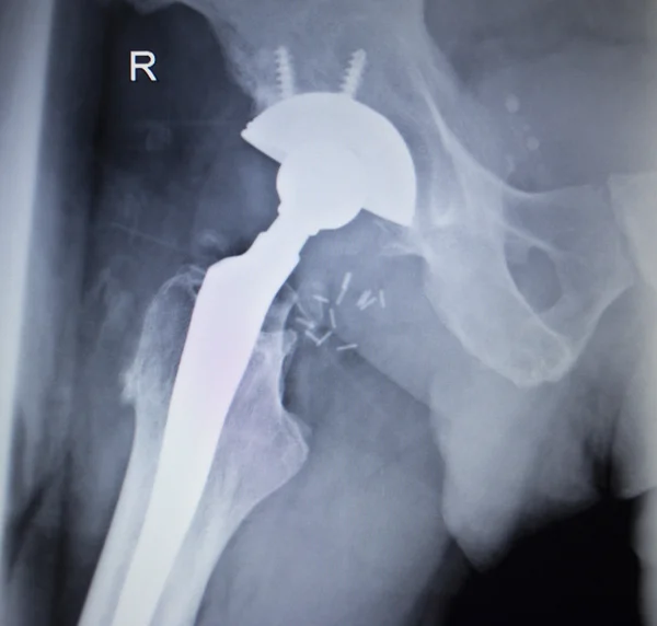 X-ray skanowania obraz stawu biodrowego wymiany implantów ortopedycznych — Zdjęcie stockowe