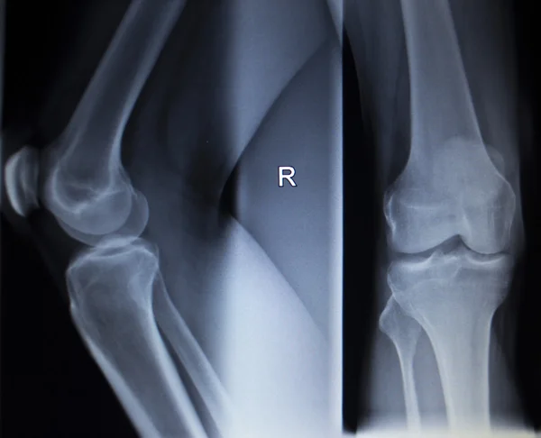 X-ray orthopedics scan of painful knee meniscus leg injury — Stock Photo, Image