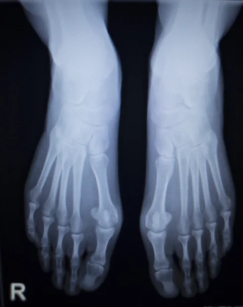 X-ray skanowania ortopedii kontuzji stopy przedniej, tylnej Ap — Zdjęcie stockowe