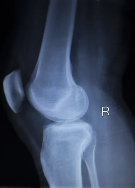 Рентгенівська ортопедія сканує болючу травму ноги на колінах — стокове фото
