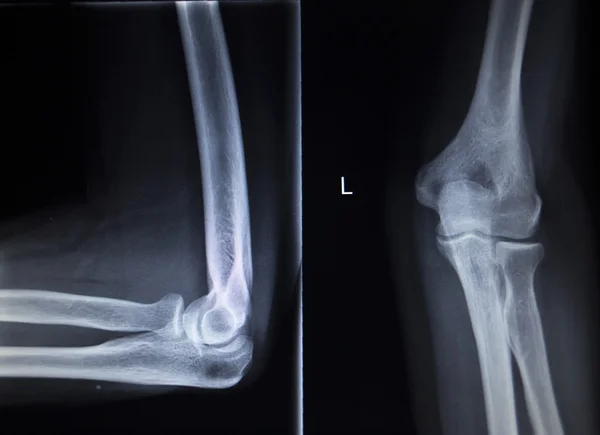 Radiographie orthopédique Traumatologie scan des lésions articulaires du coude — Photo