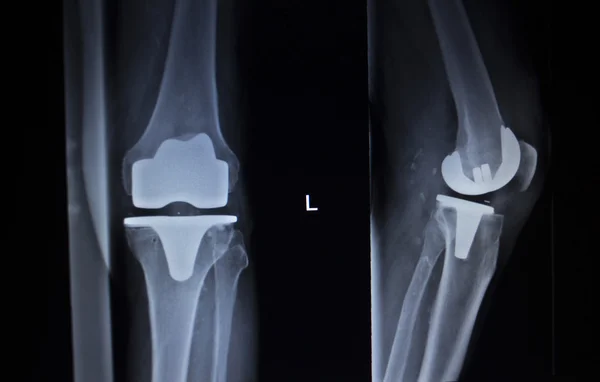 X-ray scan ortopedie kolena meniskus implantát protézy — Stock fotografie