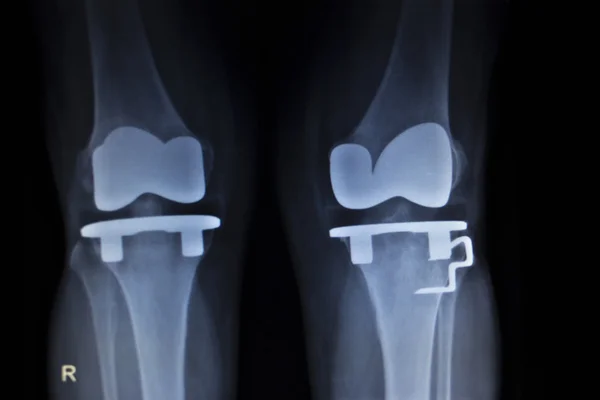 X-ray orthopedics scan of knee meniscus implant prosthetics — Stock Photo, Image