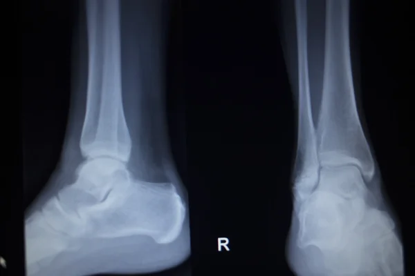 Exploración ortopédica por rayos X de lesión dolorosa en el pie del tobillo — Foto de Stock