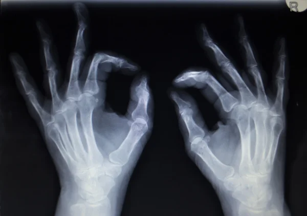 Röntgen-Orthopädie-Traumatologie-Scan der Handfingerverletzung — Stockfoto