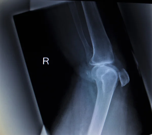 膝の痛み半月板脚損傷の x 線を整形 — ストック写真