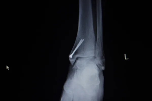 Radiografia ortopédica varredura de tornozelo pé lesão parafuso implante — Fotografia de Stock