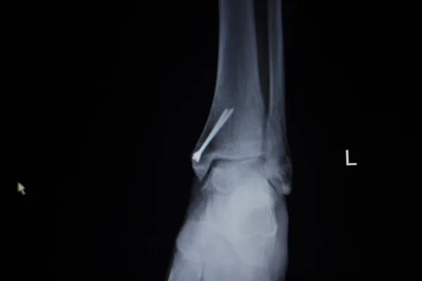 X-ray orthopedics scan of painful ankle foot injury — Stock Photo, Image