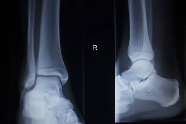 X-ray orthopedics scan of painful ankle foot injury — Stock Photo, Image