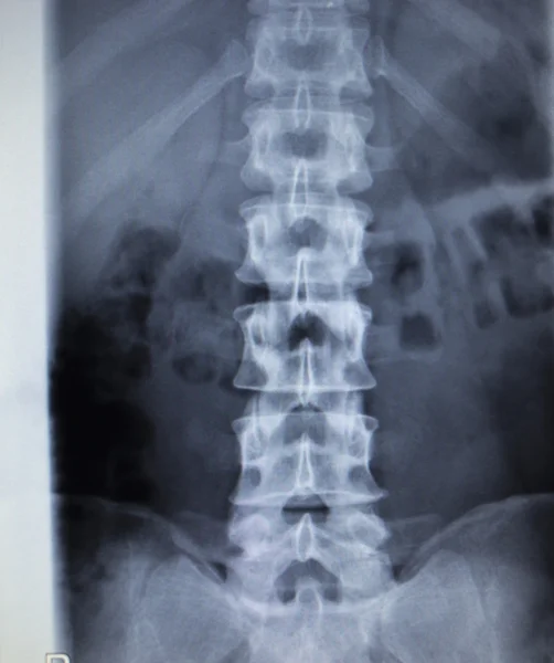 Ortopedia por rayos X Traumatología exploración dolor de espalda lesión en la columna vertebral — Foto de Stock