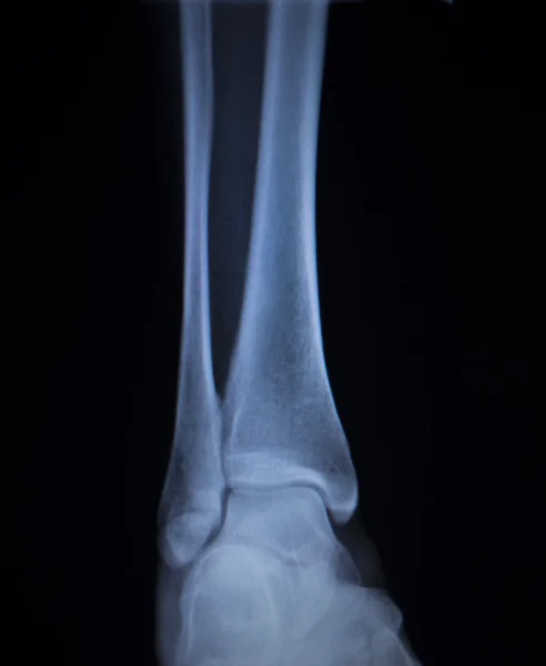 Ακτινογραφία σάρωσης ορθοπεδική επώδυνη αστράγαλο πόδι τραυματισμού — Φωτογραφία Αρχείου