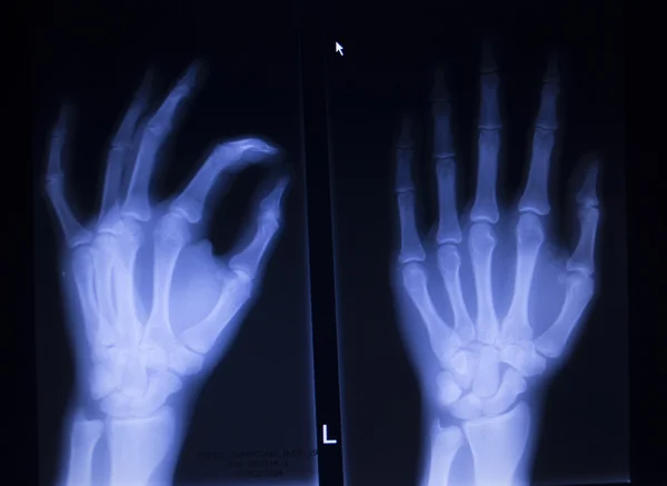 Röntgen-Orthopädie-Traumatologie-Scan der Handfingerverletzung — Stockfoto