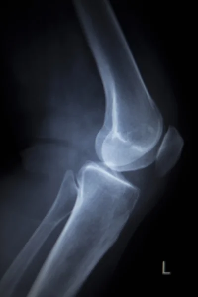 Röntgen-Orthopädie-Scan von Knie-Meniskus-Implantat-Prothesen — Stockfoto