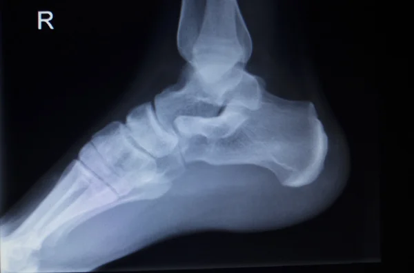 Radiographie orthopédique scan de blessure au pied — Photo