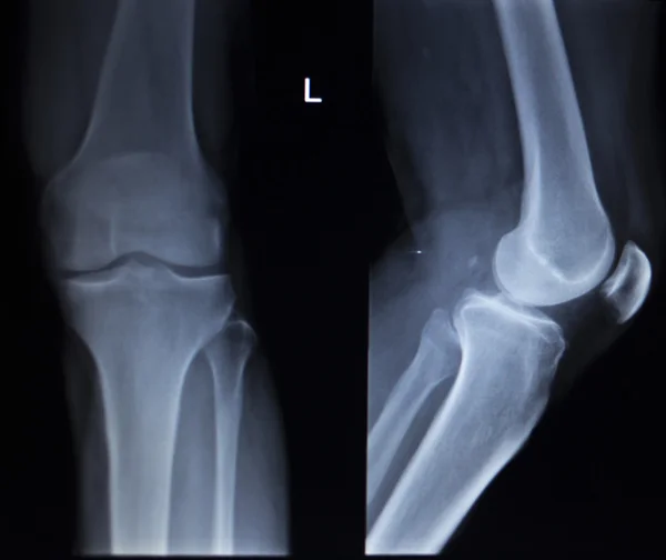 Exploración ortopédica por rayos X de lesión dolorosa en la pierna del menisco de la rodilla — Foto de Stock