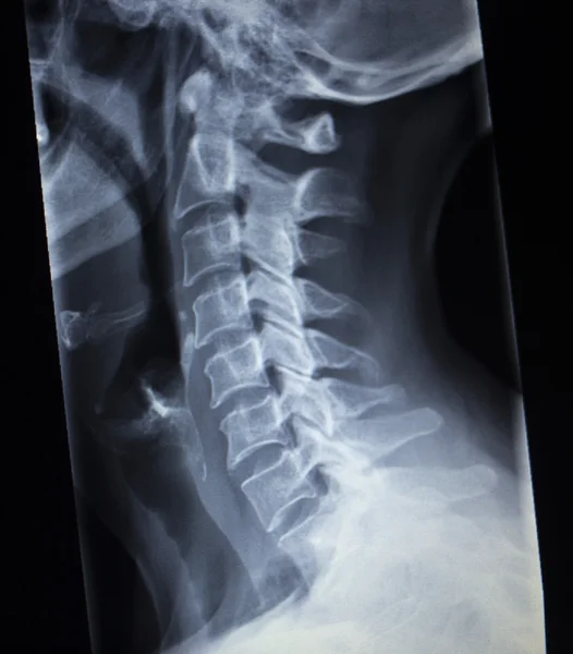 X-ray orthopedics Traumatology scan of neck injury — Stock Photo, Image