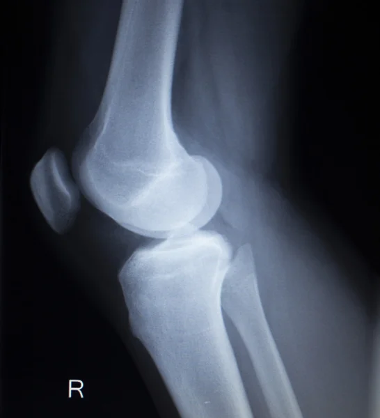 Radiografia ortopédica de lesão dolorosa na perna do menisco do joelho — Fotografia de Stock