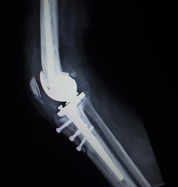 Radiografia ortopédica varredura de próteses de implante de menisco de joelho — Fotografia de Stock