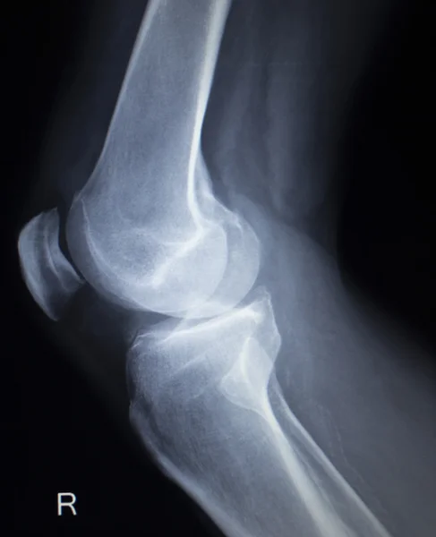 X 선 정형 외과 검사 고통 스러운 무릎 초승달 모양 다리 부상 — 스톡 사진