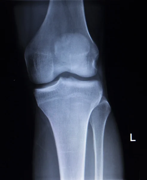 Exploración ortopédica por rayos X de lesión dolorosa en la pierna del menisco de la rodilla — Foto de Stock