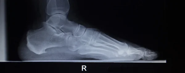 X-ray scan ortopedie nést váhu zatížení zranění nohy — Stock fotografie
