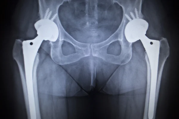 X-Ray σάρωση εικόνας της άρθρωση του ισχίου αντικατάσταση ορθοπεδικών εμφυτευμάτων Εικόνα Αρχείου