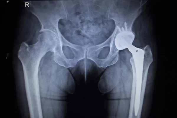 X-Ray σάρωση εικόνας της άρθρωση του ισχίου αντικατάσταση ορθοπεδικών εμφυτευμάτων Εικόνα Αρχείου